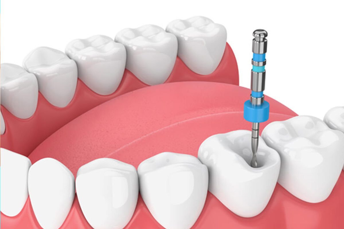 Ace Medicare Offers Root Canal Treatment and Other Dental Surgeries for Better Patient Centricity