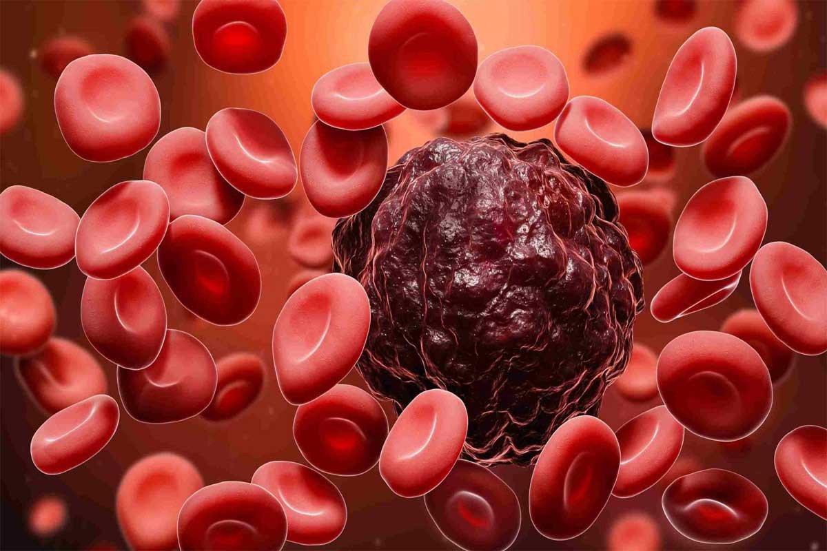 Understanding the Different Types of Blood Cancer and the Significance of Early Diagnosis