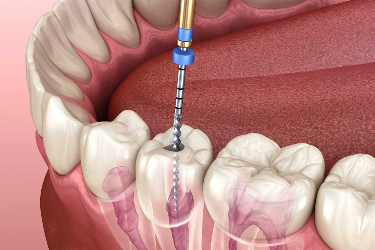 Exceptional Root Canal Treatment at Ace Medicare: A Trusted Name in Dental Care