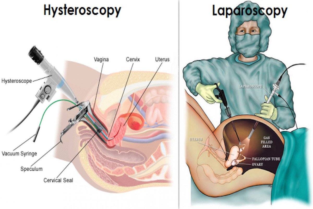 Exploring the Benefits of Hysteroscopy: A Window into Women's Health