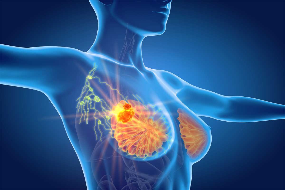 Surgeries To Treat Breast Cancer: A Quick Guide