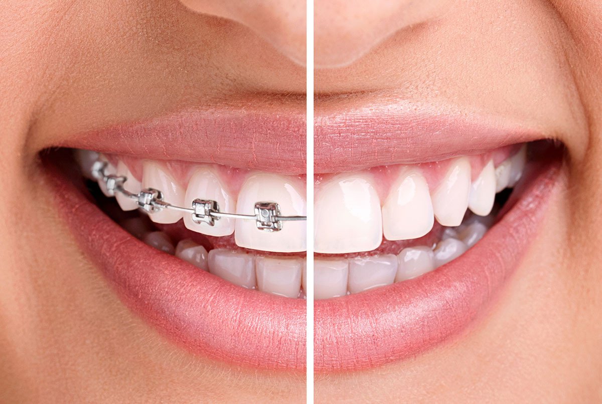 Dental Braces and Teeth Whitening: Impacts your beauty and overall health
