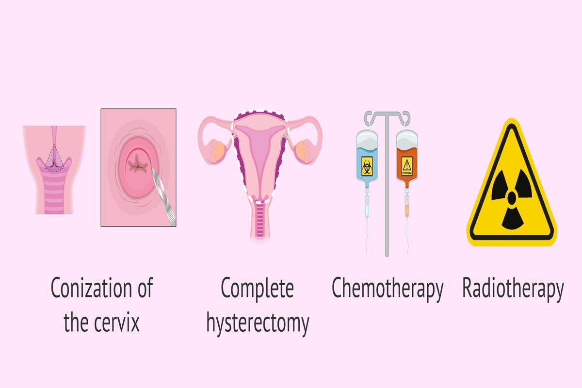 A Complete Guide to Cervical Cancer Treatment