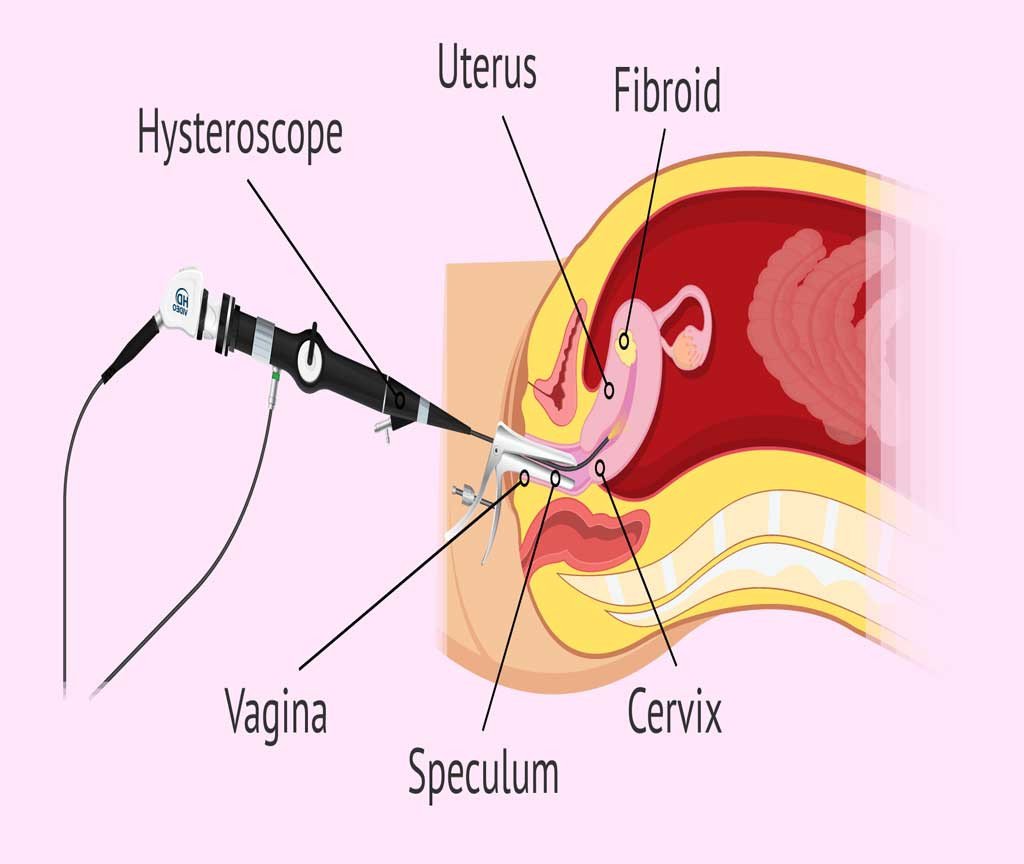 A Comprehensive Guide to Hysteroscopy