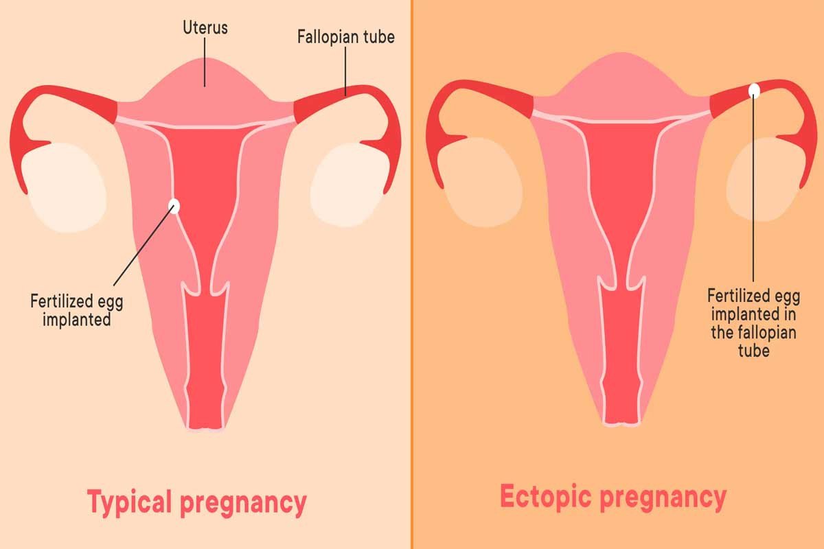 What Foods to Eat and Avoid After Ectopic Pregnancy Surgery?