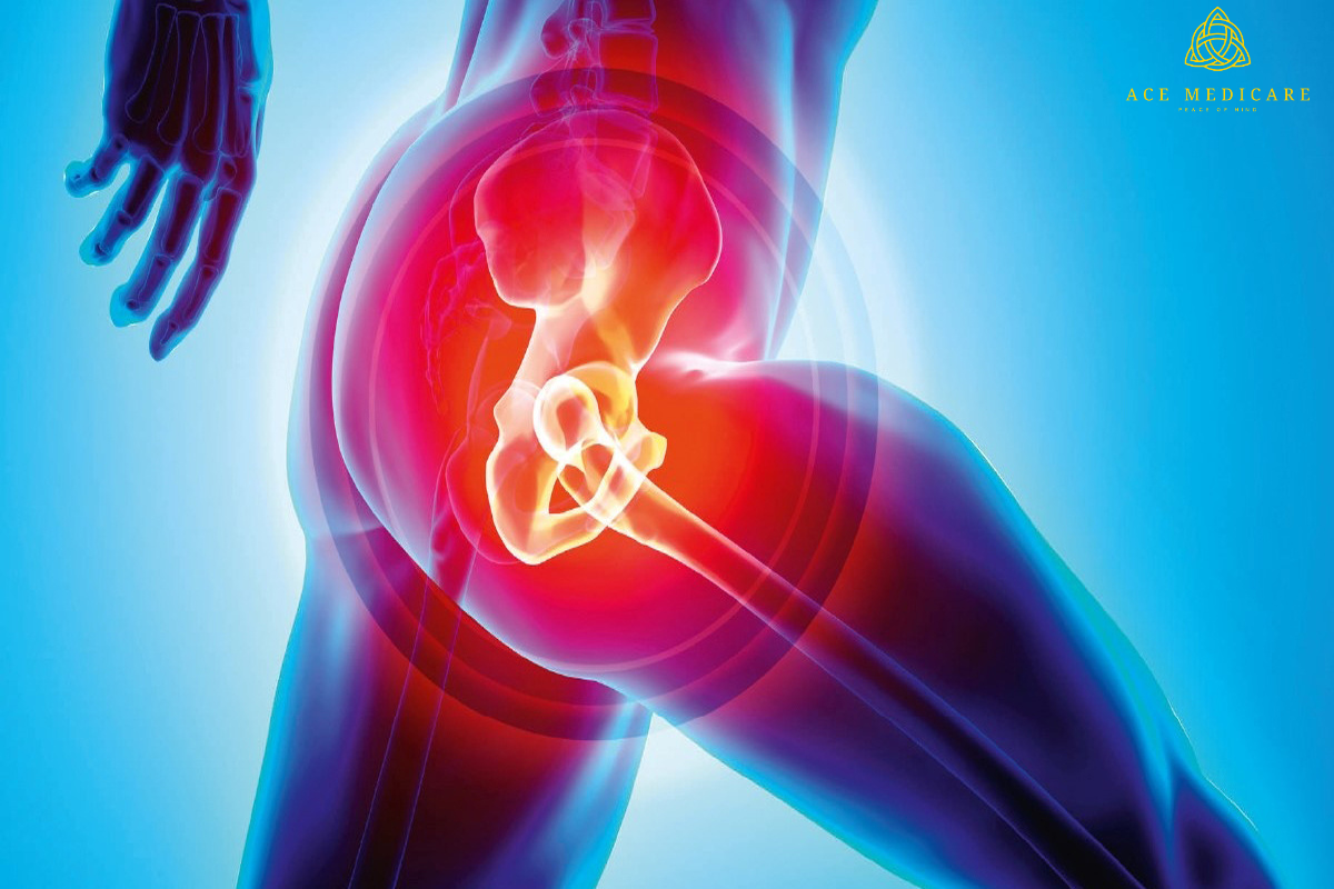 Exploring the Different Types of Hip Replacement Procedures