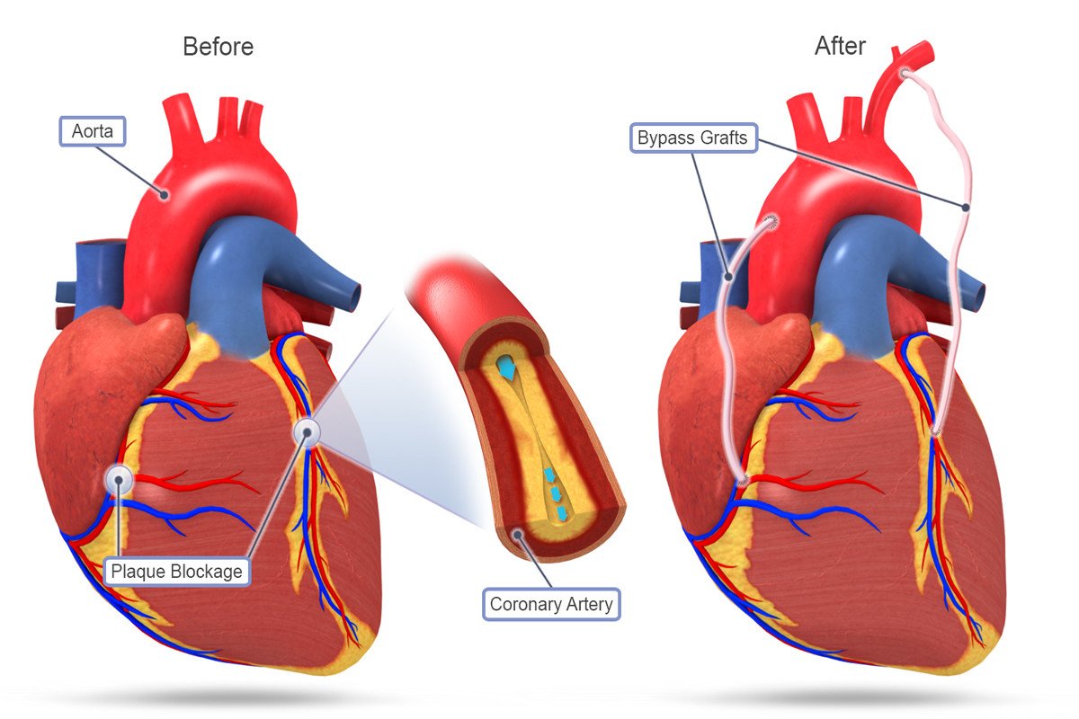 Coronary Artery Bypass Surgery: Restoring Heart Health and Vitality