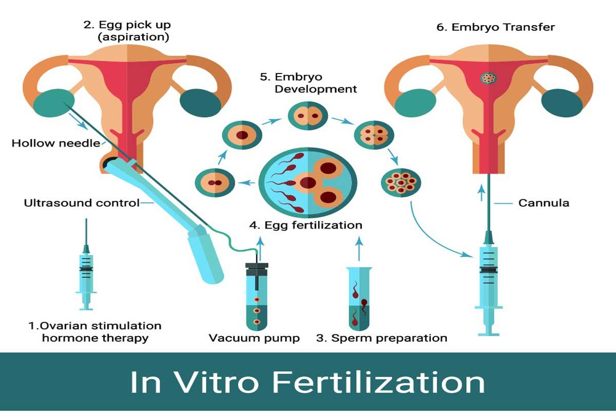 Explaining the Different Stages of the IVF Process