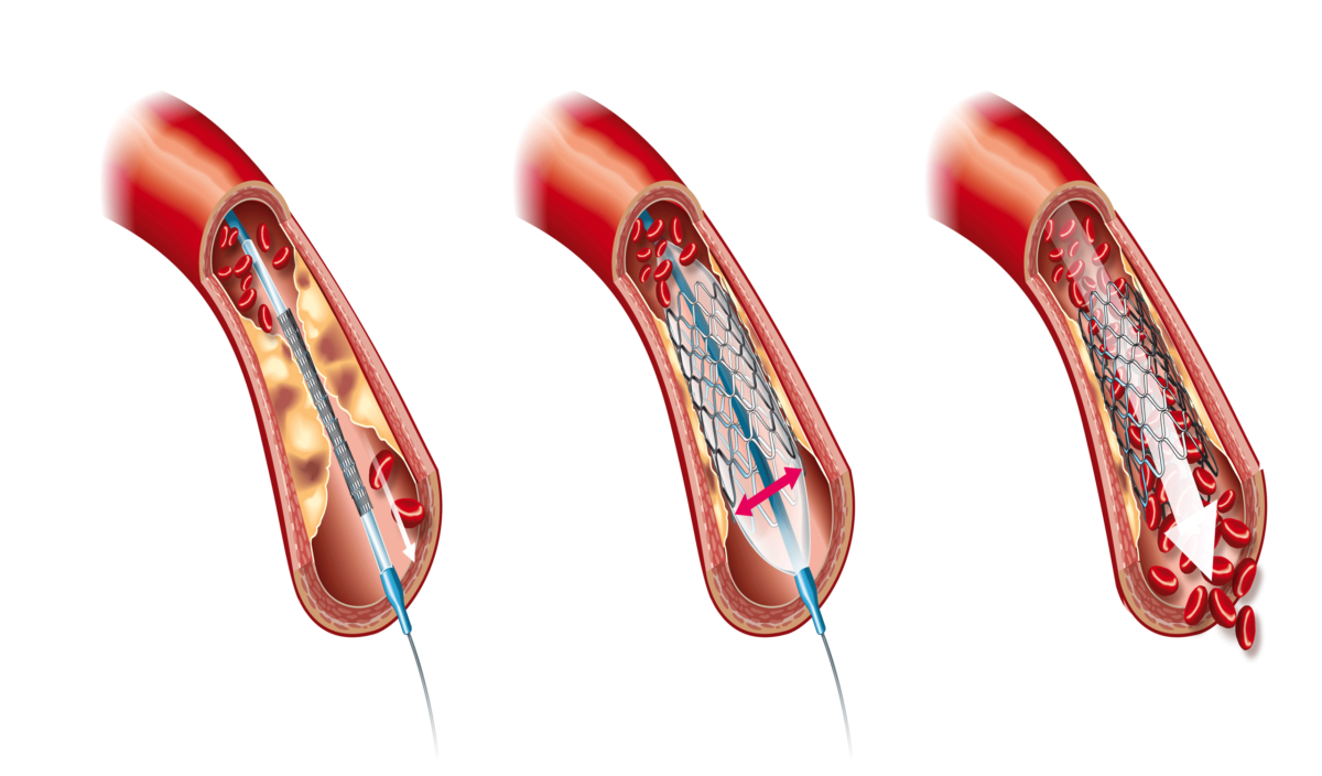 What is Angioplasty with a Stent?