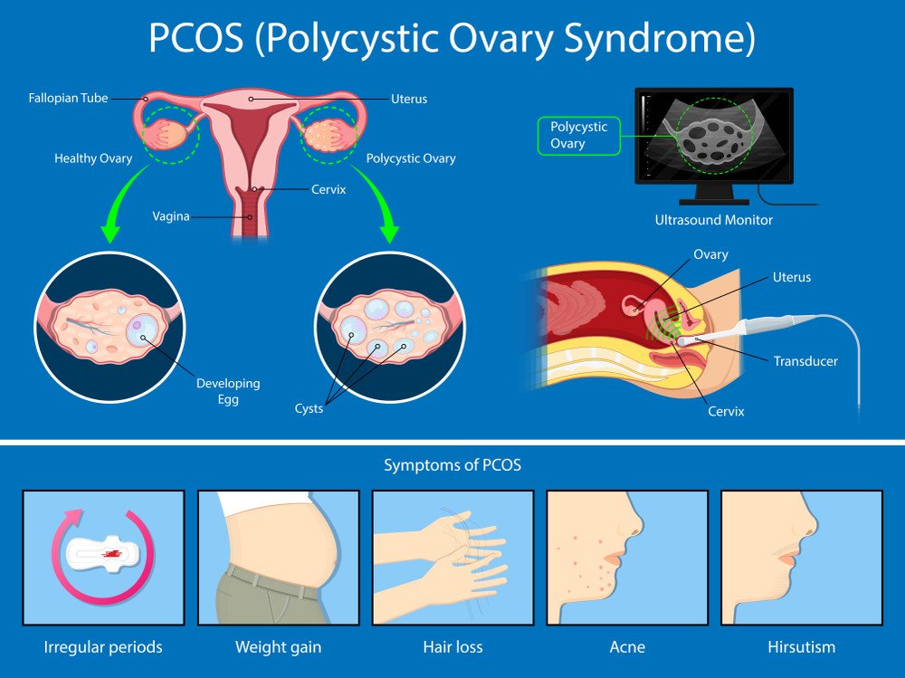 PCOD and Infertility: Understanding the Connection