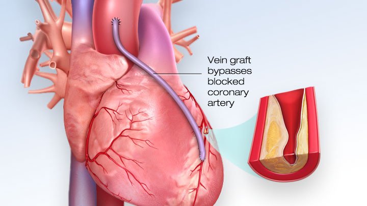 Coronary artery bypass surgery at Ace Medicare