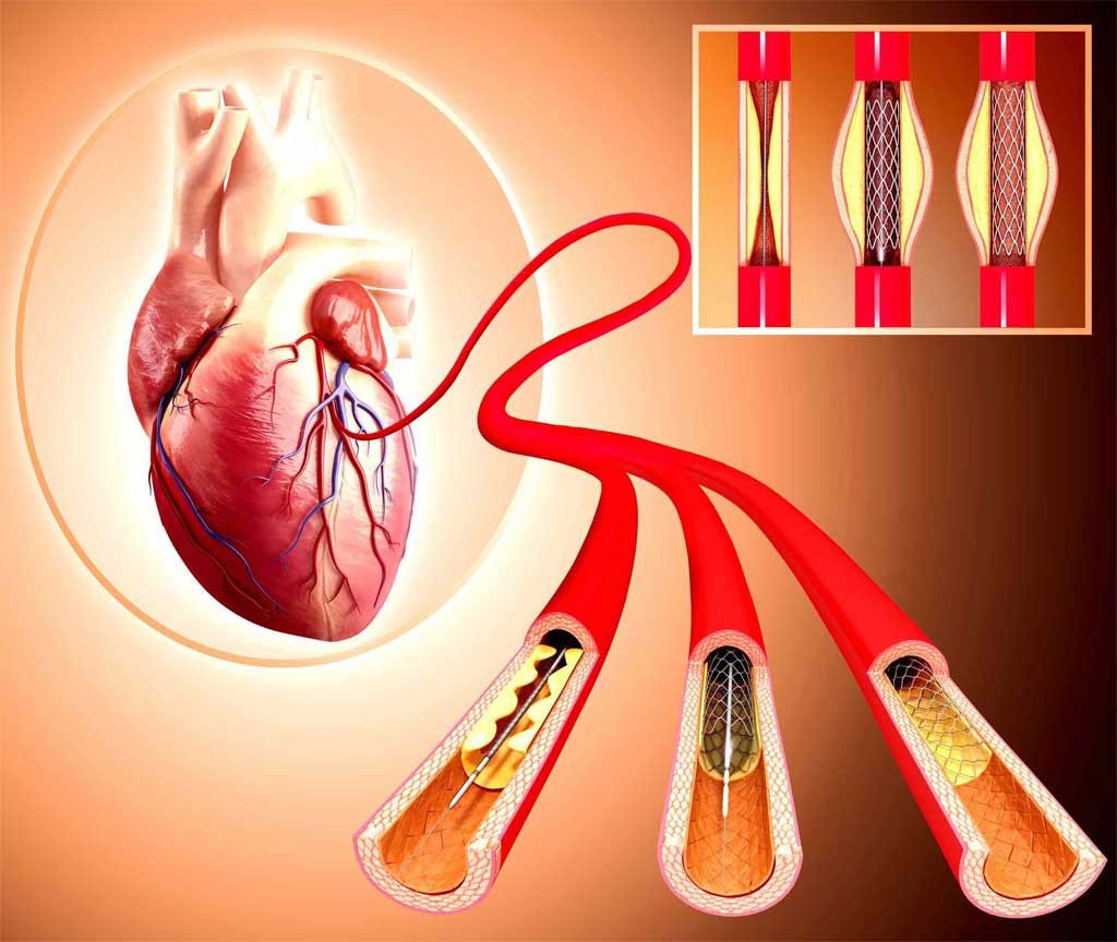 Angioplasty – The Saviour of the Heart!