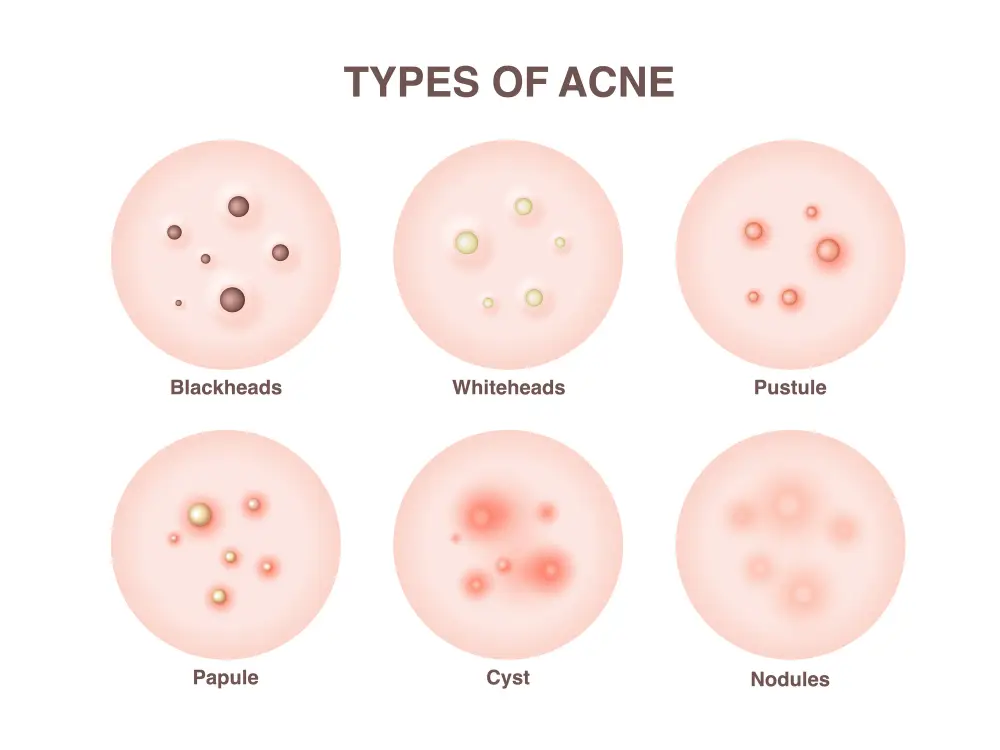 Understanding Acne: Causes, Types, and Treatment Options