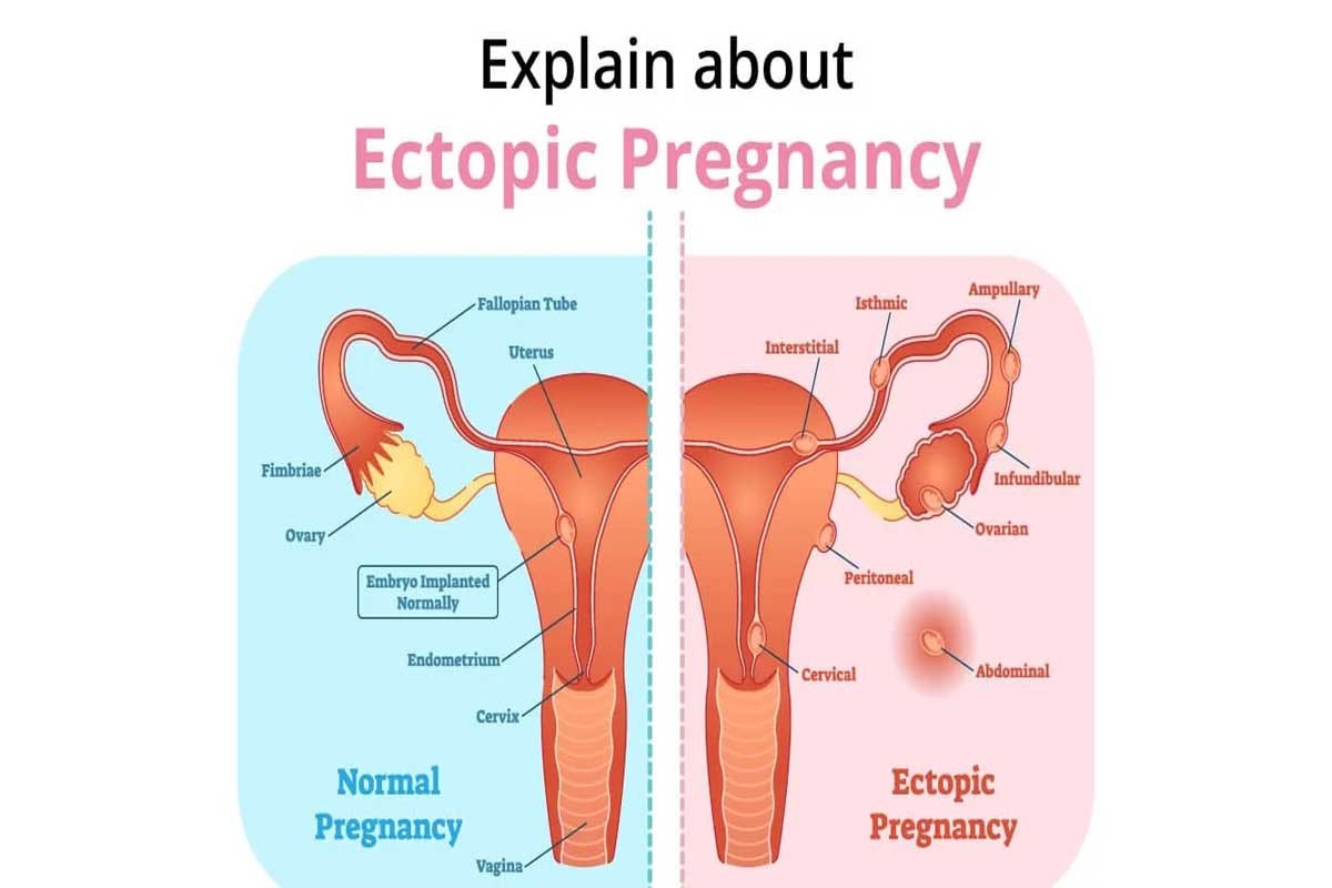 Ectopic Pregnancy: What are the symptoms and treatment process?