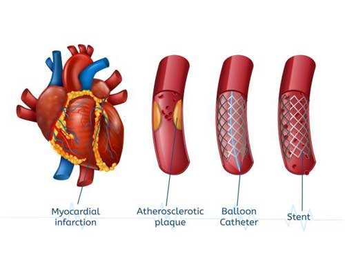 Angiography & Angioplasty, Stent