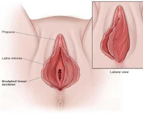 Labiaplasty, Vaginal lips