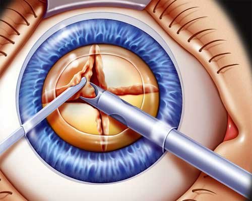 Cataract Surgery, Motiyabind