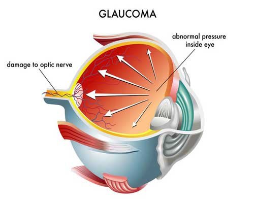 Glaucoma Treatment, Kala Motiyabind