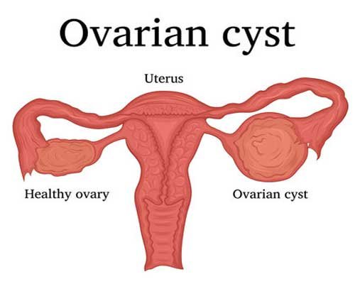 Ovarian Cysts, Andashay ka Ganth