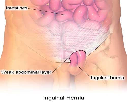 Hernia surgery - Medicover