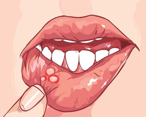 Mouth Ulcers, Muh ke Chhale