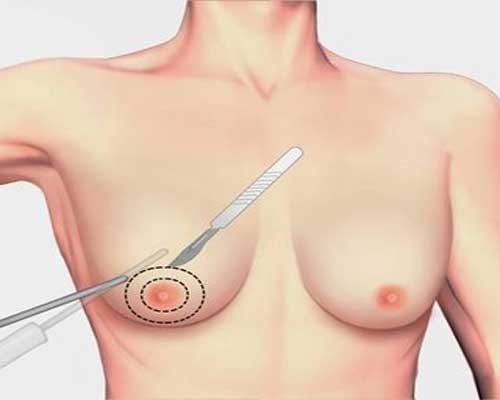 Enlarged Male Breasts, Gynecomastia